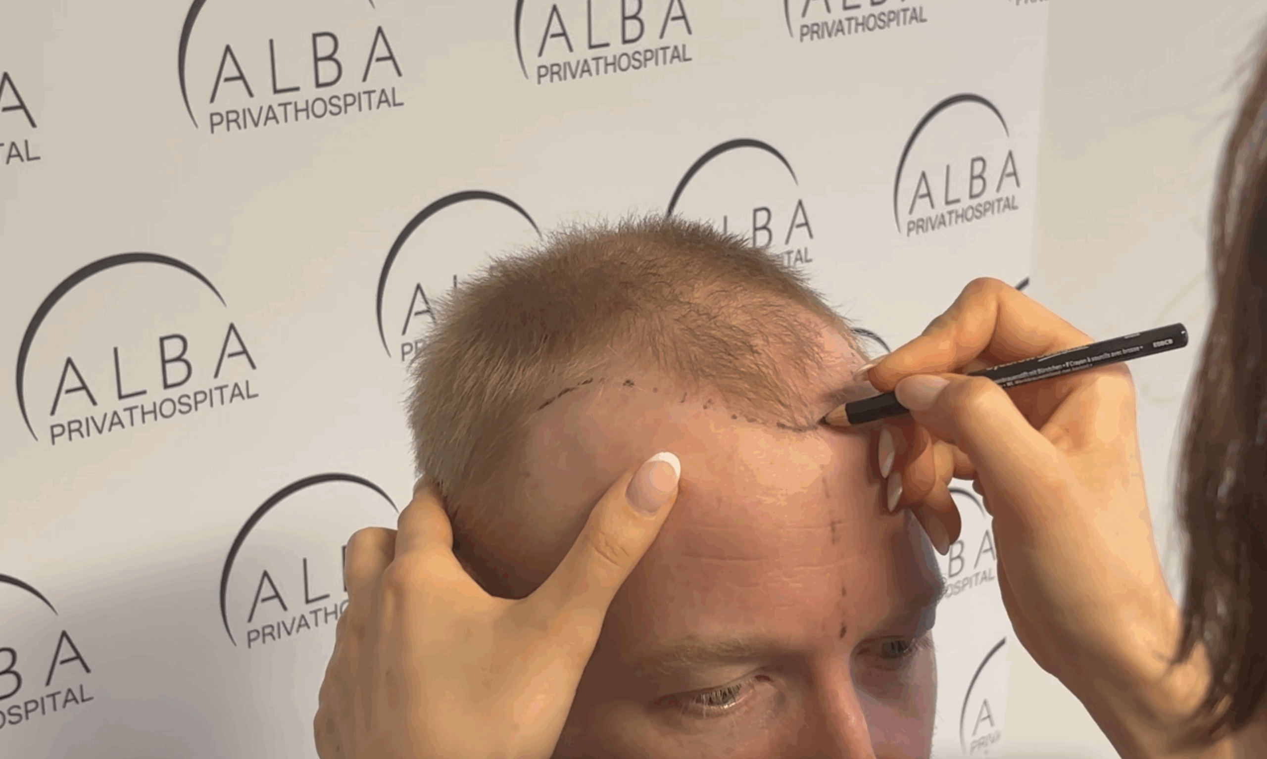 En person får tegnet hårgrænsen på hovedet før en hårtransplantation på ALBA Privathospital.